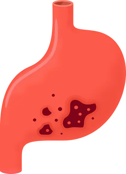 Medical Illustration of Stomach Ulcers