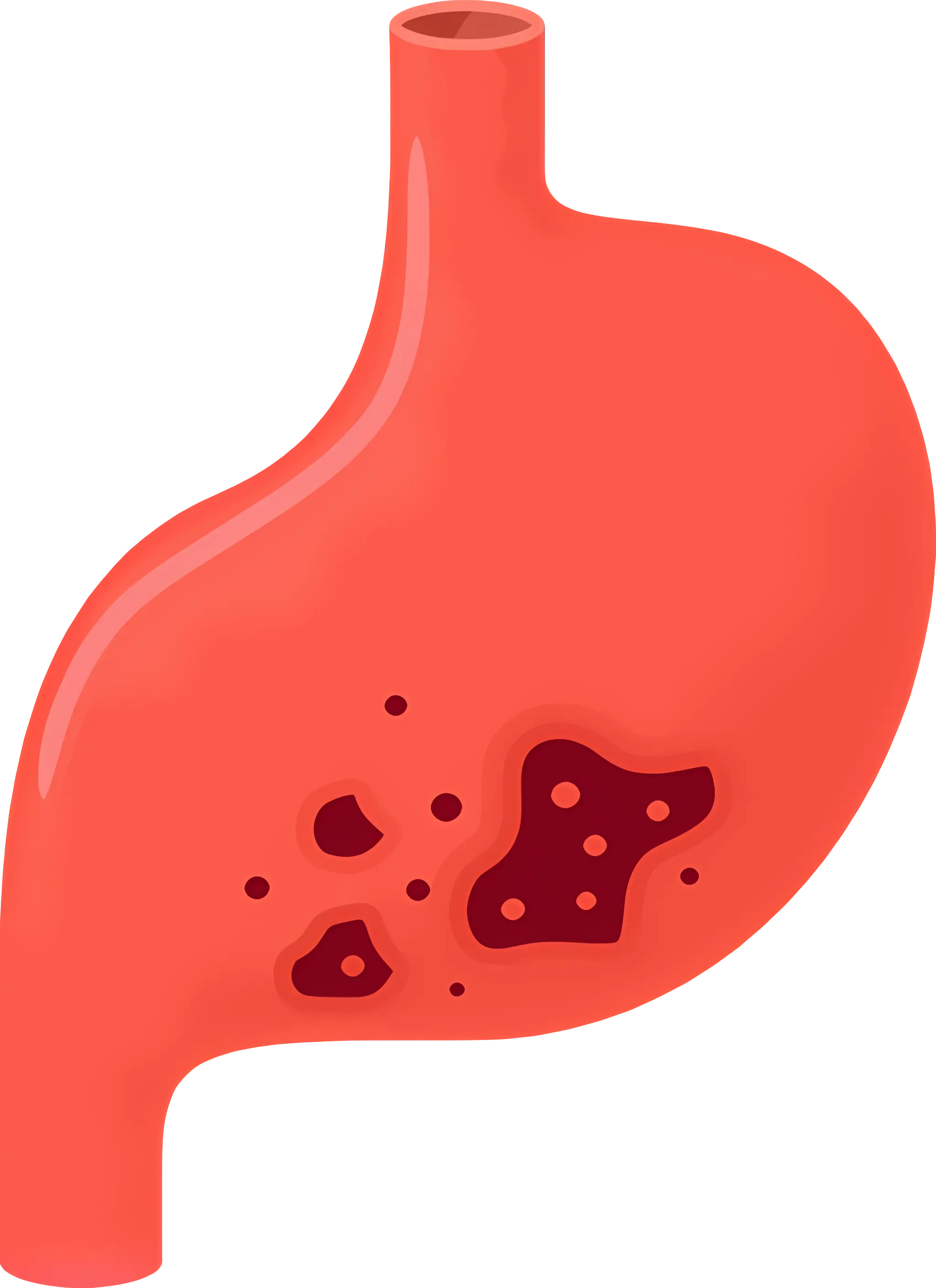 Medical Illustration of Stomach Ulcers