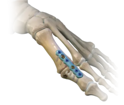 Foot Bone with Surgical Plate