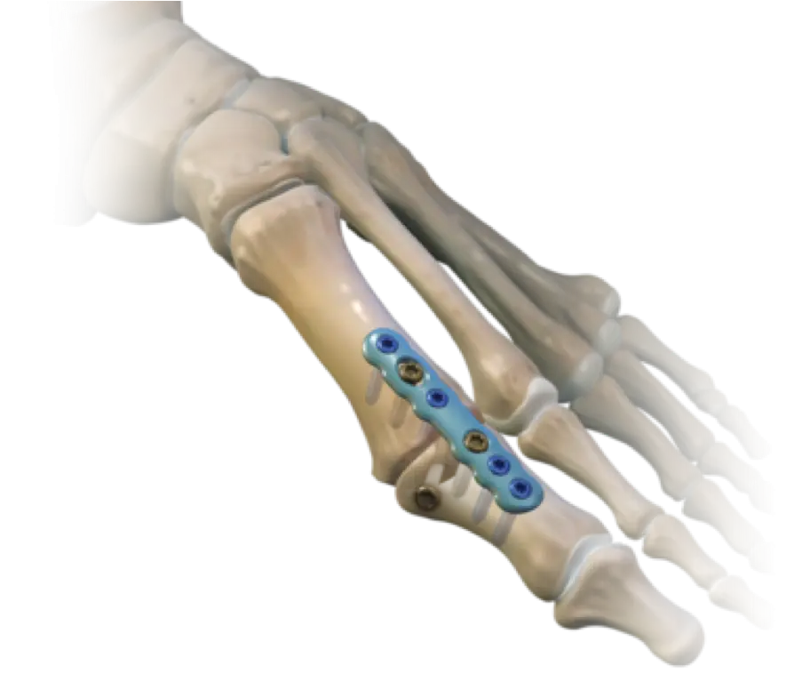 Foot Bone with Surgical Plate