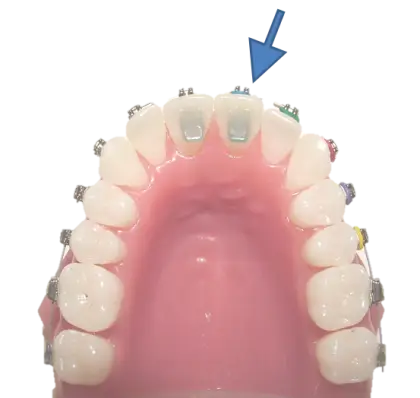 Dental Braces for Teeth Alignment