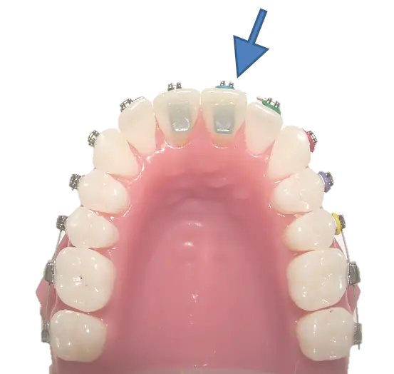 Dental Braces for Teeth Alignment