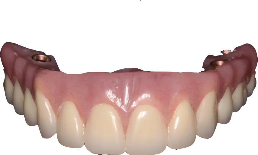 Artificial Dental Prosthesis Design