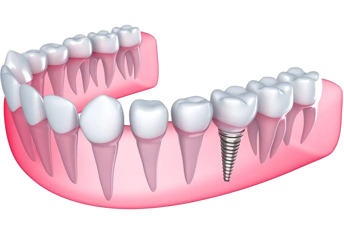 Dental Implant and Teeth Illustration