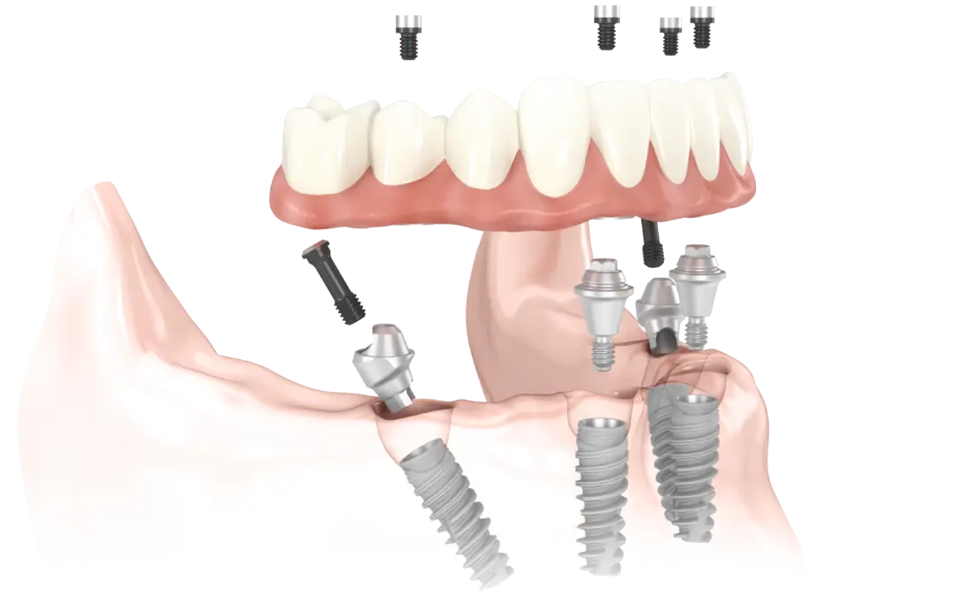 Dental Implants Illustration