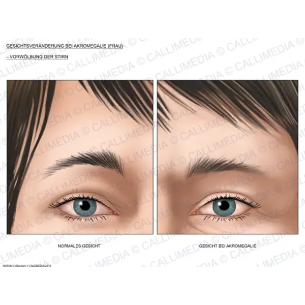 Eye Illustration Medical Comparison