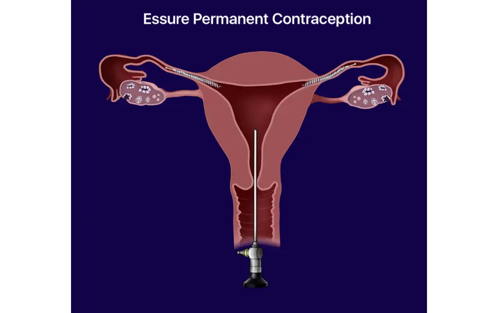 Essure Permanent Contraception Device
