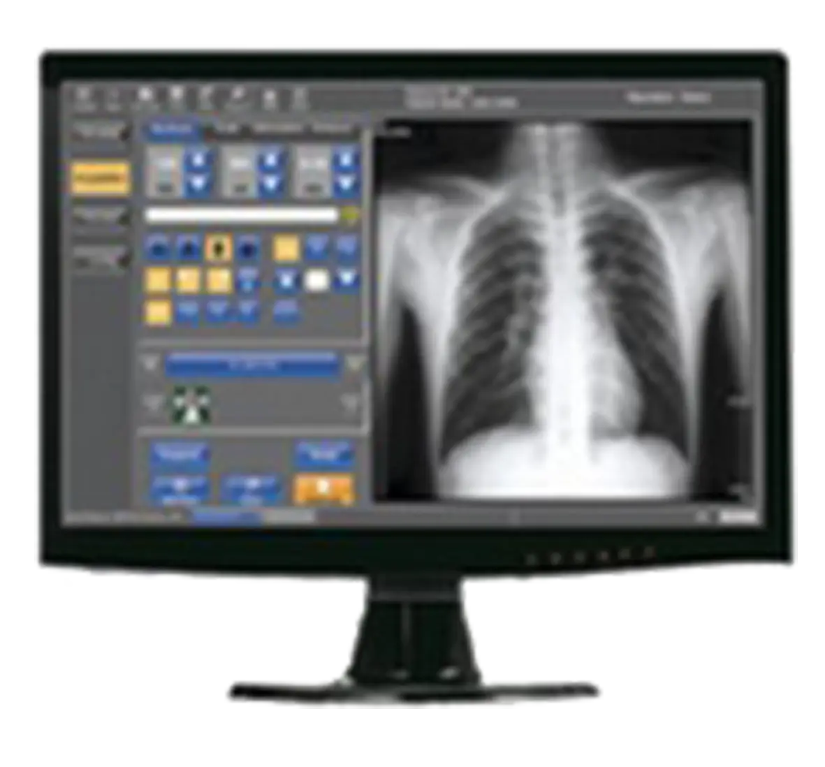 X-ray Monitor Displaying Chest Image