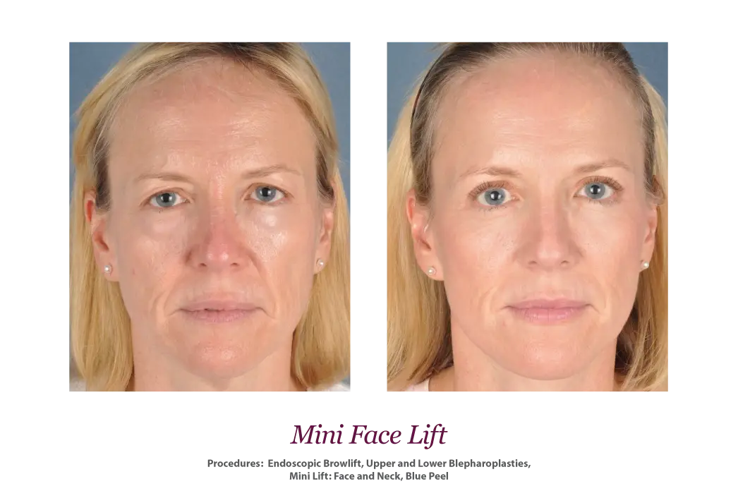 Face Lift Before and After Comparison
