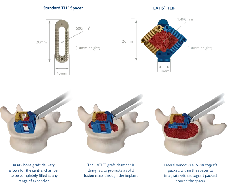 Spinal Implant Procedure Diagram