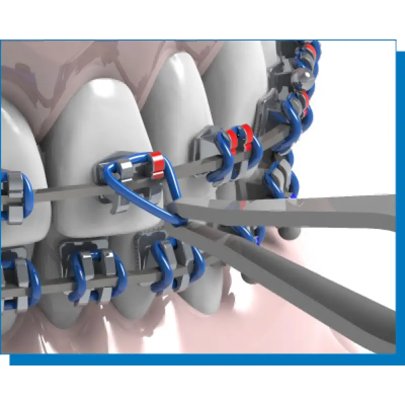 Dental Braces for Teeth Alignment