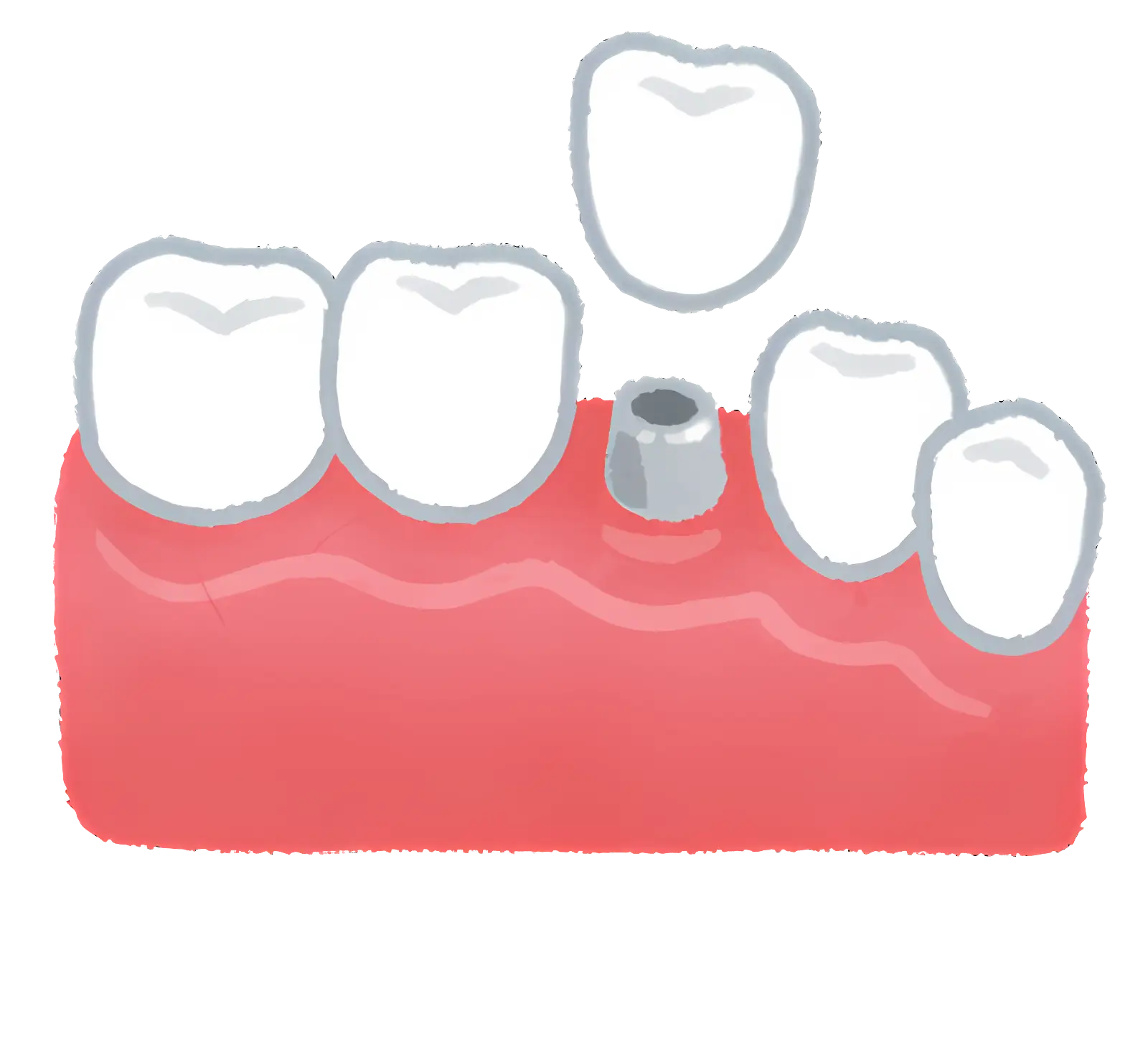 Dental Implant Illustration