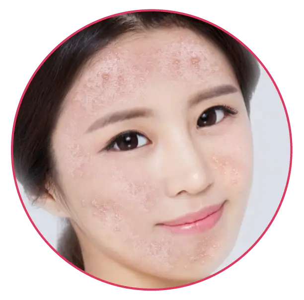 Woman with Skin Condition on Face