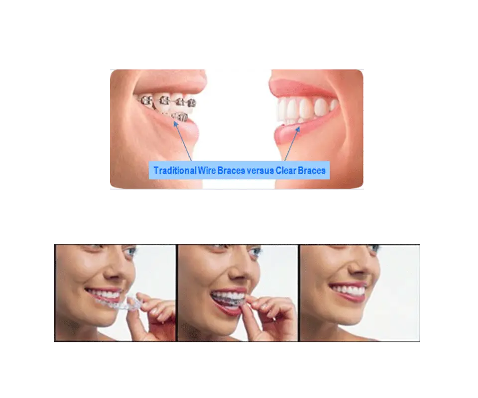 Traditional vs Clear Braces