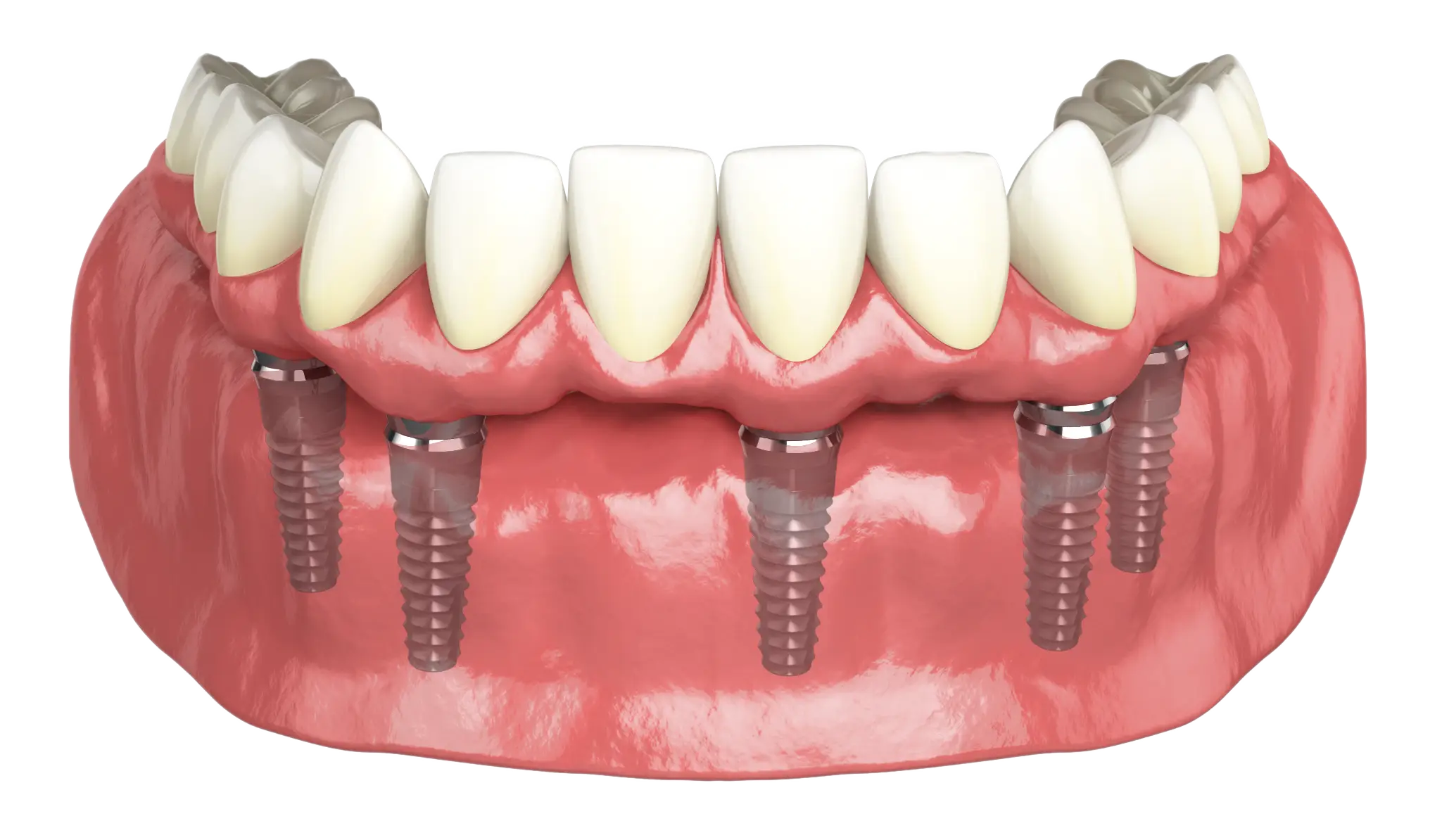 Illustration of Dental Implants