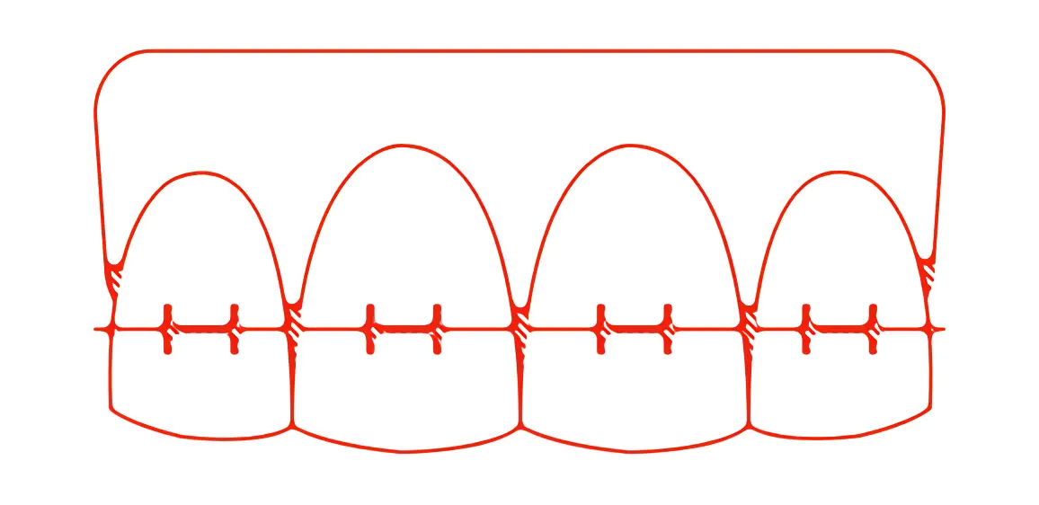 Teeth with Braces Illustration