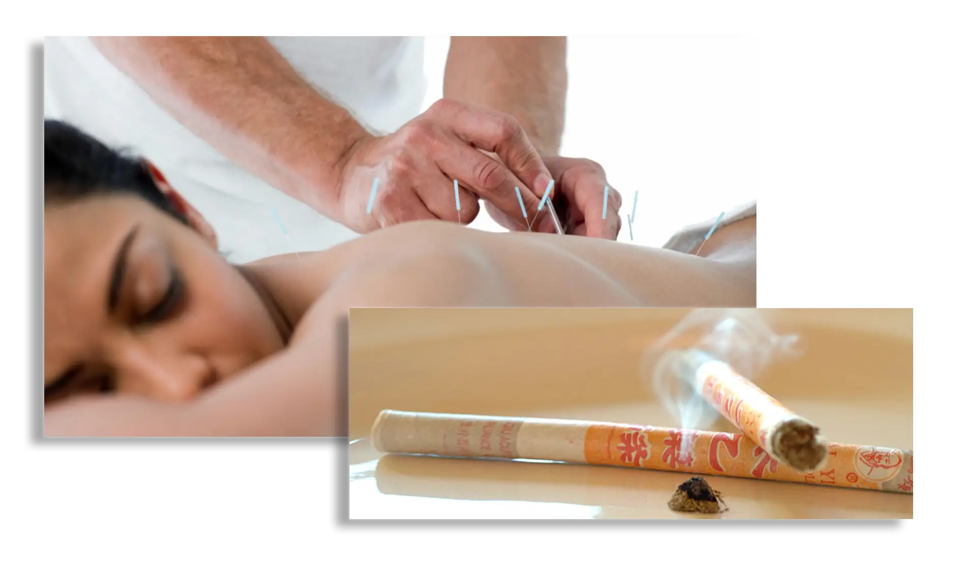 Acupuncture Treatment Session